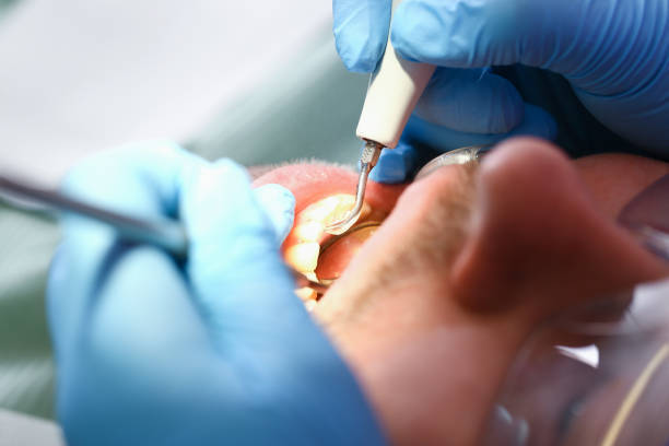 Best Broken or Chipped Tooth Repair in New London, OH